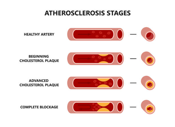 Atherosclerosis formation. Healthy and unhealthy arteries. Cholesterol plaque in the blood vessels. Atherosclerosis formation. Healthy and unhealthy arteries. Cholesterol plaque in the blood vessels isolation on white background. clogged artery stock illustrations