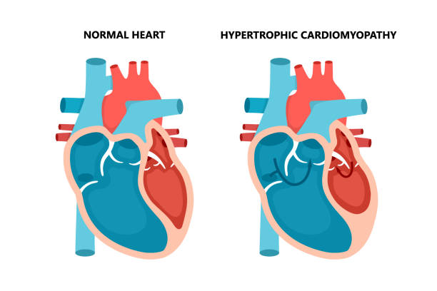 단면도를 가진 비후성 심근 병증. 인간의 심장 근육 질환. 심장학 개념. - pulse trace human cardiovascular system heart shape heart disease stock illustrations
