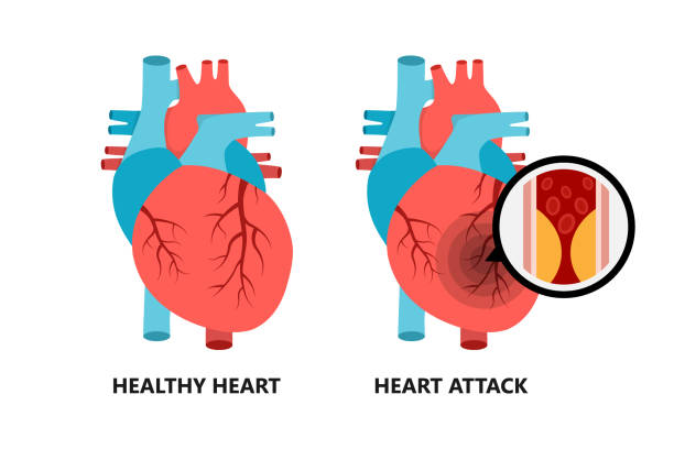 ilustraciones, imágenes clip art, dibujos animados e iconos de stock de corazón sano y no saludable. corazón con placa aterosclerótica. - pain heart attack heart shape healthcare and medicine