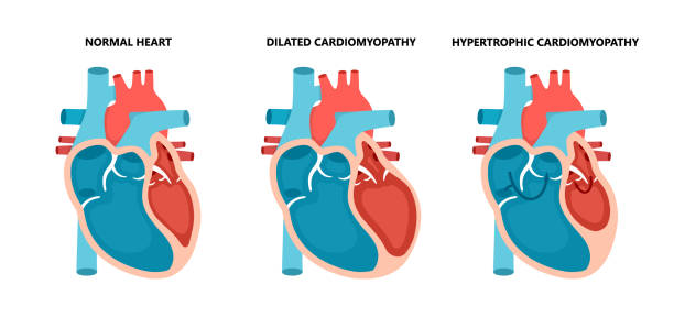 심장 질환의 종류 - 정상, 비후성 및 확장 심근 병증. 인간의 심장 근육 질환 단면. - pulse trace human cardiovascular system heart shape heart disease stock illustrations