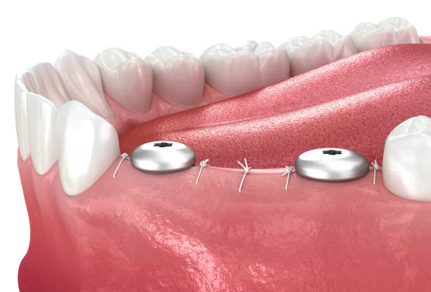 istock Gingiva former over implant. Medically accurate 3D illustration. 1406686351