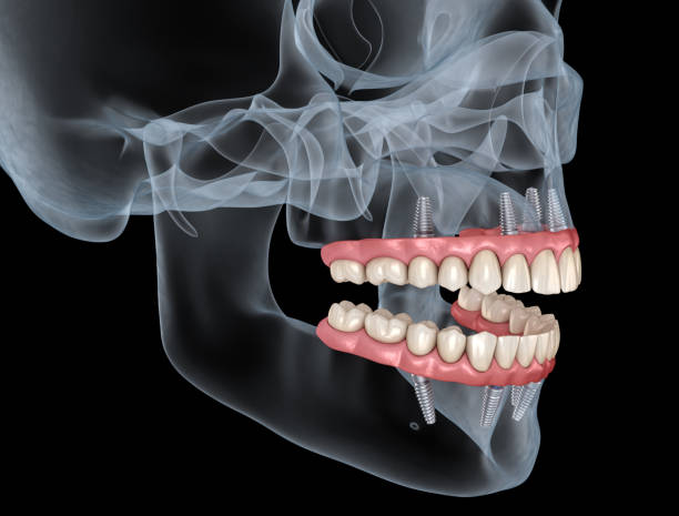 maxillary and mandibular prosthesis with gum all on 4 system supported by implants. medically accurate 3d illustration of human teeth and dentures - implantat imagens e fotografias de stock