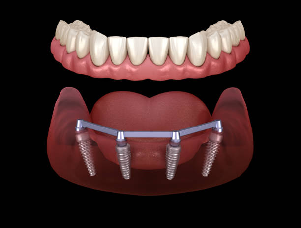 Mandibular prosthesis with gum All on 4 system supported by implants.  Medically accurate 3D illustration of human teeth and dentures concept Mandibular prosthesis with gum All on 4 system supported by implants.  Medically accurate 3D illustration of human teeth and dentures concept 4 5 years stock pictures, royalty-free photos & images