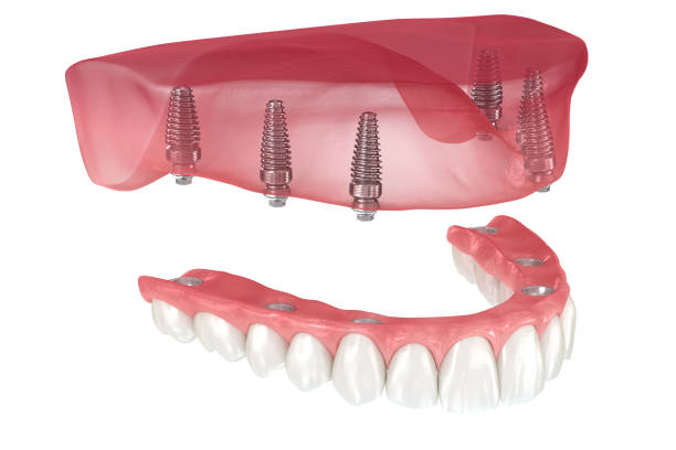 Maxillary prosthesis with gum All on 6 system supported by implants. Dental 3D illustration Maxillary prosthesis with gum All on 6 system supported by implants. Dental 3D illustration Full Arch Implants stock pictures, royalty-free photos  images
