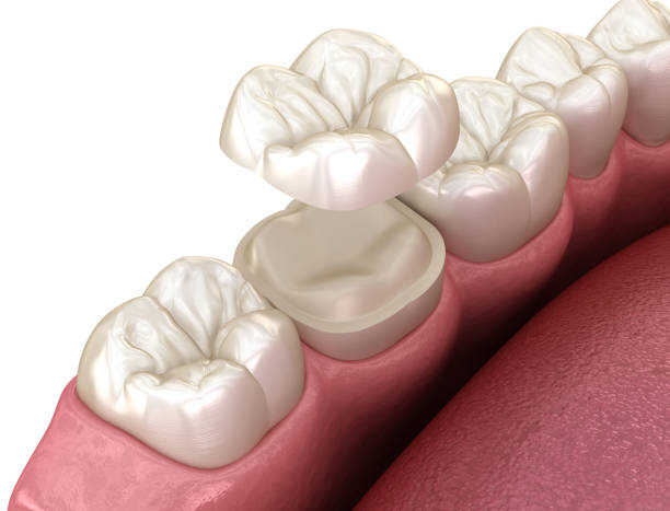 fixation de couronne en céramique d'onlay au-dessus de la dent. illustration 3d médicalement précise du traitement humain de dents - inlaid photos et images de collection