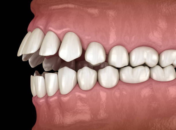 istock Openbite dental occlusion (Malocclusion of teeth). Medically accurate tooth 3D illustration 1406686454