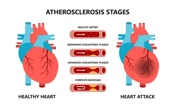 illustrazioni stock, clip art, cartoni animati e icone di tendenza di fasi di infarto e aterosclerosi. arterie sane e malsane. colesterolo nei vasi sanguigni. - human artery cholesterol atherosclerosis human heart