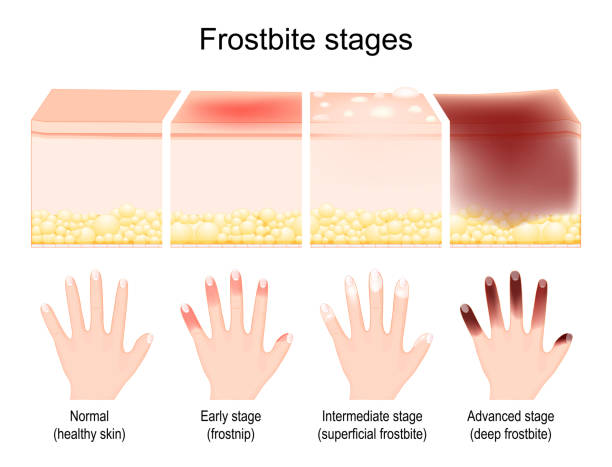 ilustrações de stock, clip art, desenhos animados e ícones de frostbite stages. skin injury after freezing - intermediate