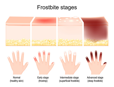 Frostbite stages. The symptoms in progress. comparison of skin injury after freezing. Humans fingers on a palm after Early stage or frostnip, Intermediate stage or superficial frostbite and deep or Advanced frostbite. Vector illustration