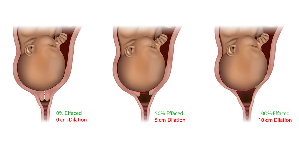 Cervical Effacement and Dilation During Delivery. Cervix, Labor or delivery. Cervix changes from not effaced and dilated to fully effaced and totally