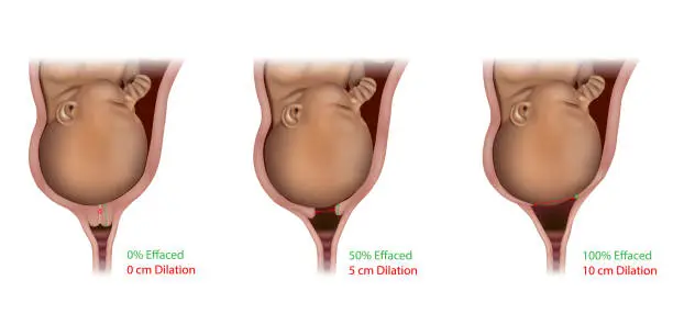 Vector illustration of Cervical Effacement and Dilation During Delivery. Labor or delivery. Cervix changes from not effaced and dilated to fully effaced and totally