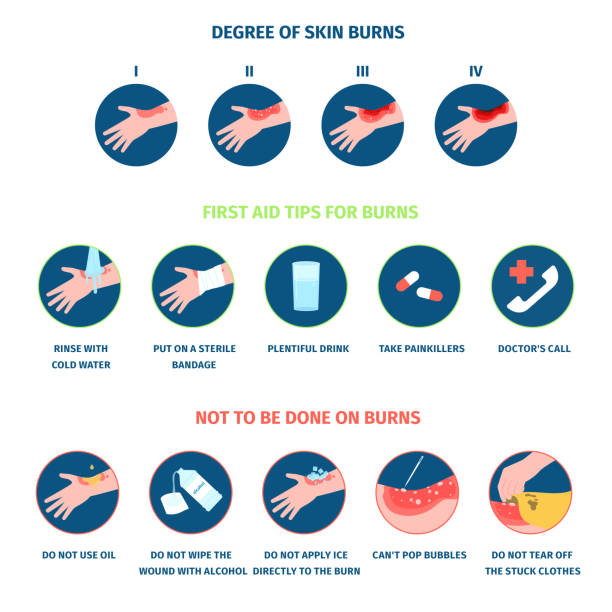 illustrations, cliparts, dessins animés et icônes de les étapes de la brûlure de la peau infographie et le traitement. types de brûlures thermiques, mains brûlantes et soins médicaux. sécurité du feu, premiers soins de la peau du corps une blessure affiche vectorielle récente - second skin