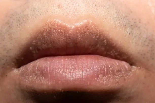 close up of Fordyce Spots on Lips.