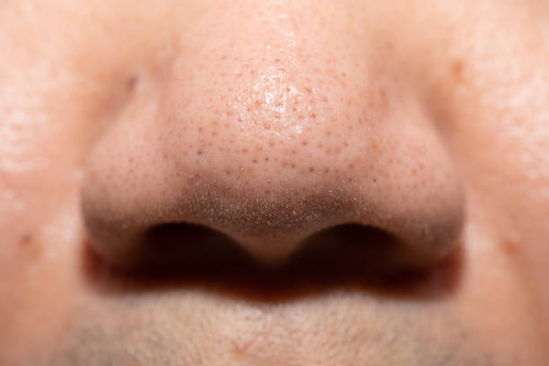 istock Pimples, clogged acne around the nose of men 1406841490