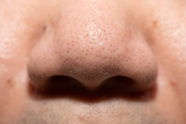 Pimples, clogged acne around the nose of men Pimples, clogged acne around the nose of men human nose stock pictures, royalty-free photos & images
