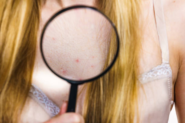 istock Woman with skin problem acne on neckline 1406880188