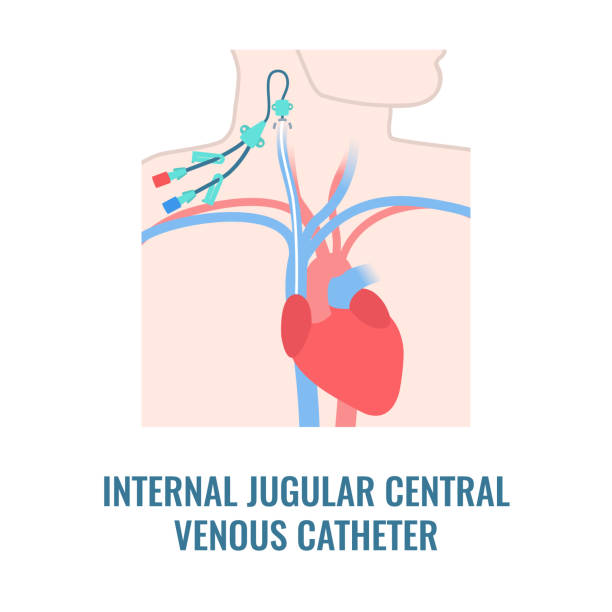 ilustraciones, imágenes clip art, dibujos animados e iconos de stock de catéter venoso central yugular interno de cerca - surgery catheter cardiac catheterization hospital