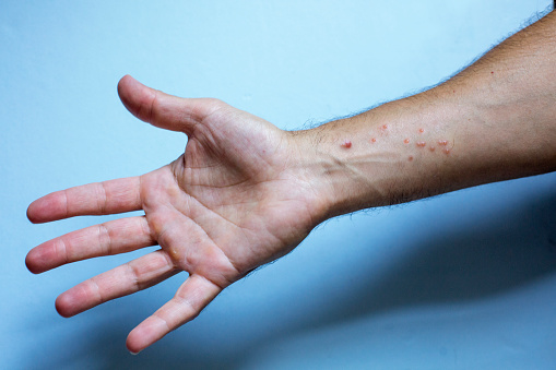 Forearm of a guy in a rash.Monkeypox virus symptoms