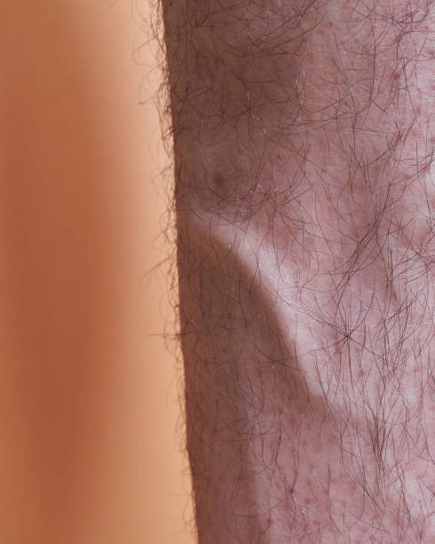 istock Leg of a man with a varicose vein 1406925046