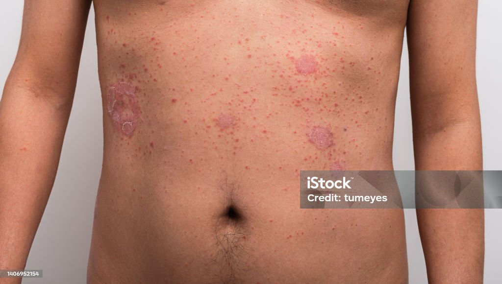 โรคสะเก็ดเงินเป็นช่องท้องบนพื้นหลังสีขาว - ไม่มีค่าลิขสิทธิ์ โรคสะเก็ดเงิน ภาพสต็อก โรคสะเก็ดเงินเป็นช่องท้องบนพื้นหลังสีขาว - ไม่มีค่าลิขสิทธิ์ โรคสะเก็ดเงิน ภาพสต็อก