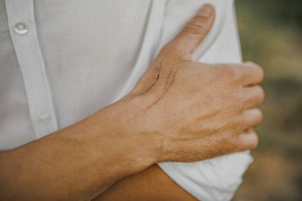 istock Cat's Scar on male skin 1406961773