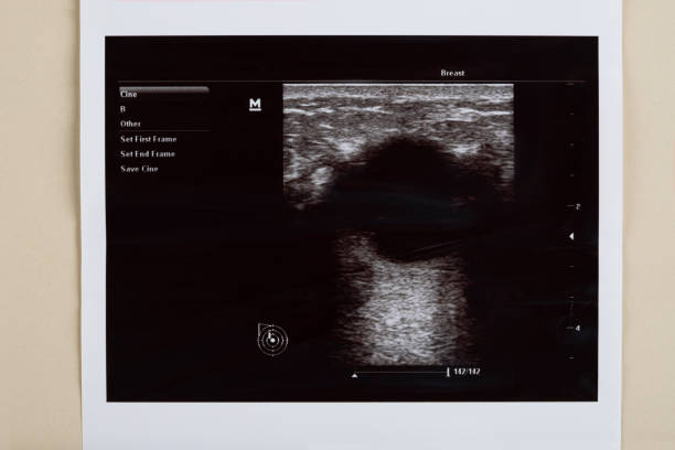 istock Ultrasound image of a breast 1406985850