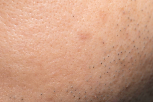 istock Asian male nose and cheek close up has skin problem 1407023843