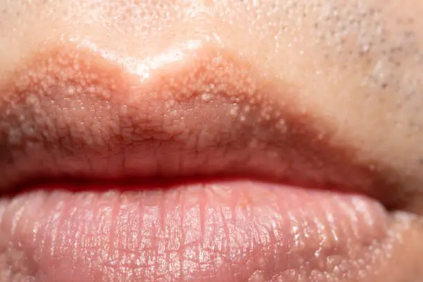 close up of Fordyce Spots on Lips