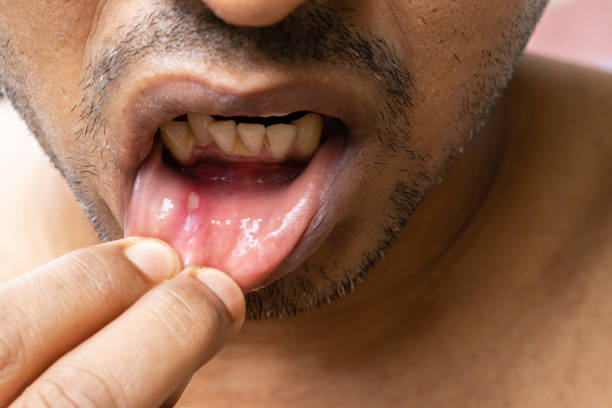 istock Painful mouth ulcer 1407043664
