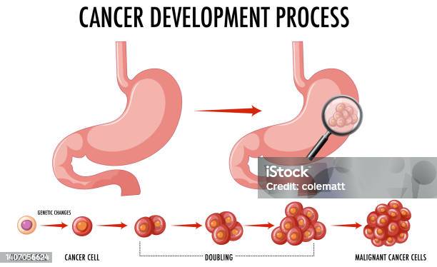 Cancer Develop Diagram Showing Cancer Development Process Stock Illustration ...
