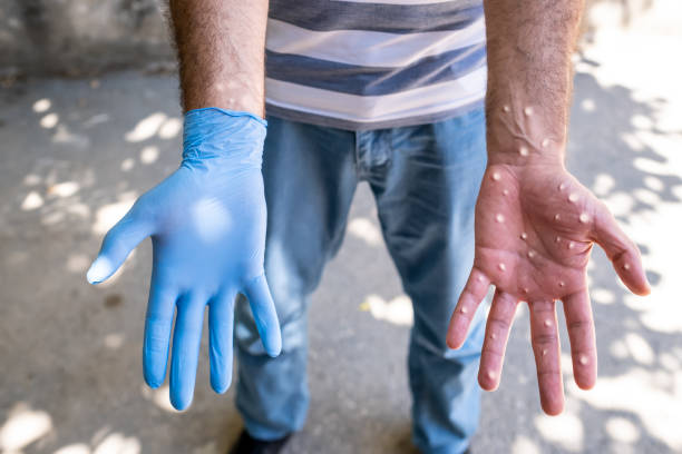 Man with blisters on his hands from monkeypox. stock photo