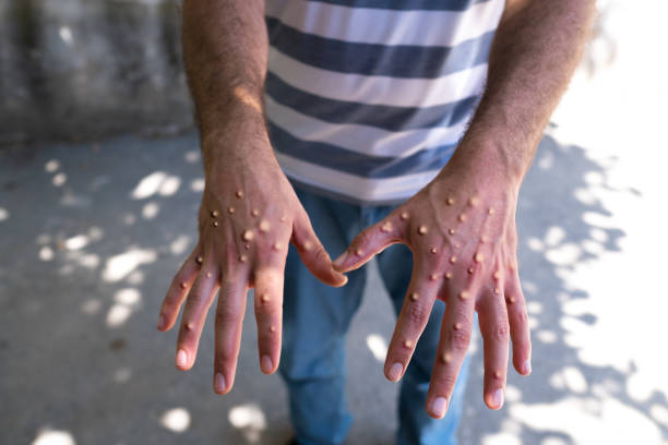 Man with blisters on his hands from monkeypox. monkey flower don't touch me lettering. not to touch to avoid virus. mpox stock pictures, royalty-free photos & images