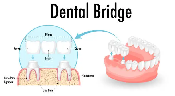 Vector illustration of Infographic of human in dental bridge on white background