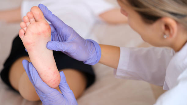 Doctor examining foot of child with red itchy rashes in clinic closeup stock photo