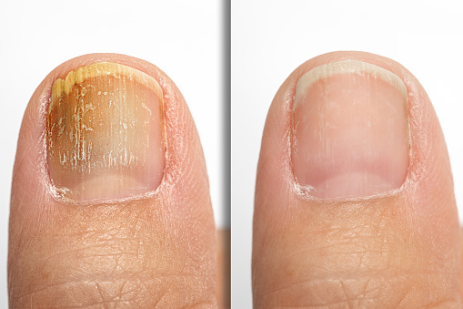 Before and after topical antifungal treatment is seen in the big toe of a person suffering from onychomycosis, a fungal infection causing yellowing of the toenail