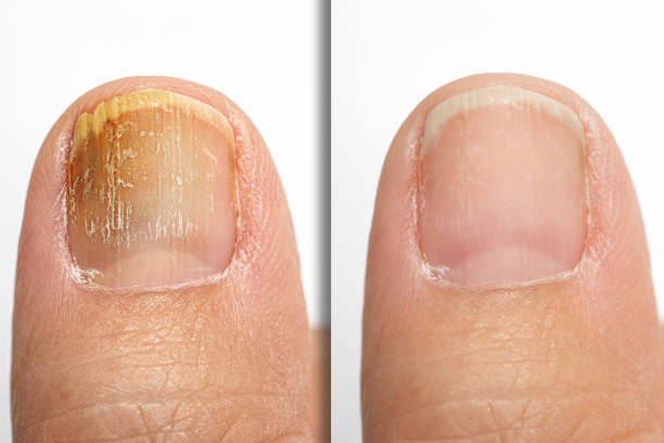 Before and after successful treatment for a fungal infection on toe Before and after topical antifungal treatment is seen in the big toe of a person suffering from onychomycosis, a fungal infection causing yellowing of the toenail toenail stock pictures, royalty-free photos & images