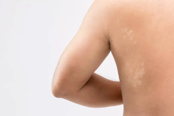 Photo of Macro white Pityriasis or Tinea Versicolor on back skin. Used for skincare concept