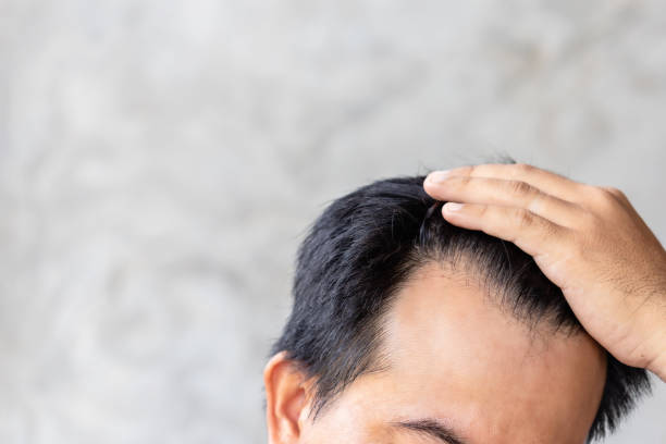 istock Man touching his head to show bald head or Glabrous problem. Copy space with grey background 1407077578