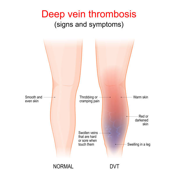 illustrations, cliparts, dessins animés et icônes de thrombose veineuse profonde. jambe saine et jambe avec tvp. signes et symptômes - thrombose