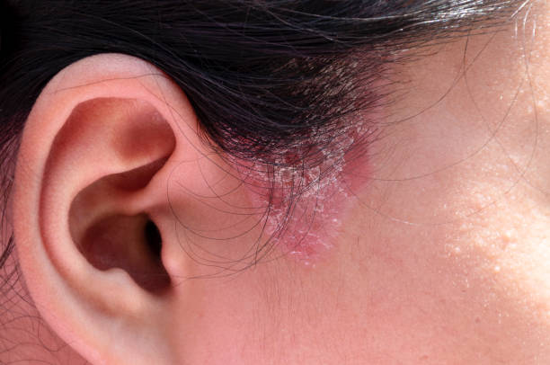 Close up sideburns girl has ringworm fungal lesions Close up sideburns girl has ringworm fungal lesions psoriasis stock pictures, royalty-free photos & images