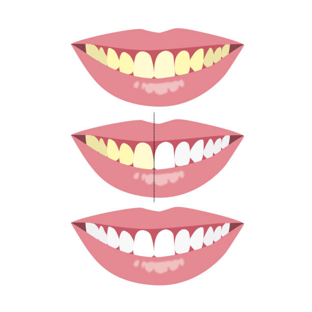 istock Compare before and after yellow and whitening tooth procedure by dentist, illustration on white background 1407232819