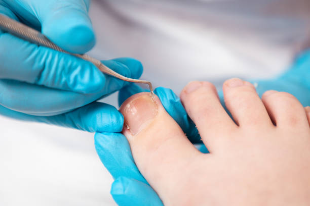 a chiropodist does a pedicure for the client's feet, cleaning the nails with a double-sided curette. close up, top view. the concept of salon professional nail care and chiropody - podiatrist podiatry pedicure chiropodist imagens e fotografias de stock