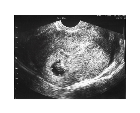 Ultrasound image of embryo of first trimester of singleton pregnancy