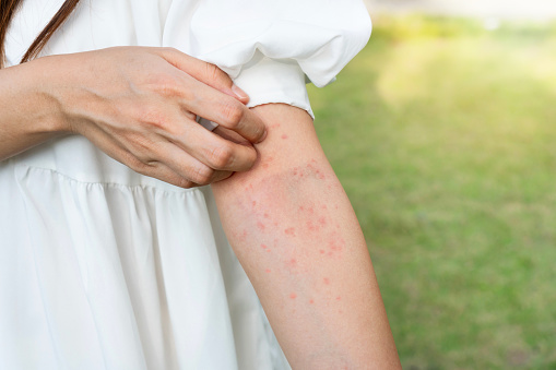 Closeup of woman hand scratching her skin itchy. Allergic rash dermatitis eczema skin, insect, food allergy, health care concept