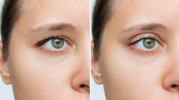 Cropped shot of young woman's face with drooping upper eyelid before and after blepharoplasty Cropped shot of a young caucasian woman's face with drooping upper eyelid before and after blepharoplasty isolated on white background. Result of plastic surgery. Changing the shape, cut of the eyes drooping stock pictures, royalty-free photos & images