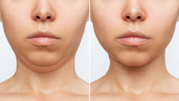 liposuzione del doppio mento. viso della donna con il mento prima e dopo la chirurgia plastica estetica - second skin foto e immagini stock
