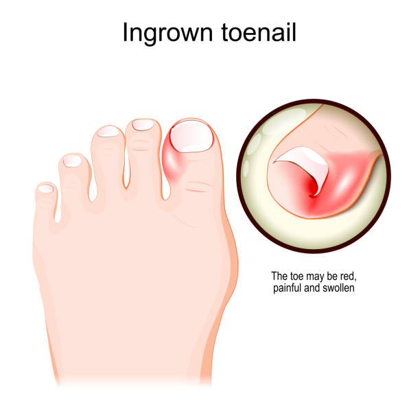 Ingrown toenail. Human foot. vector art illustration