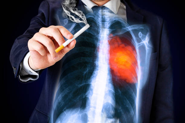 Lung cancer concept: Smoking man with lung cancer stock photo