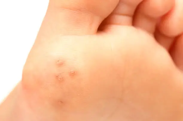 Closeup of plantar warts under foot of a child caused by HPV (human papillomavirus)
