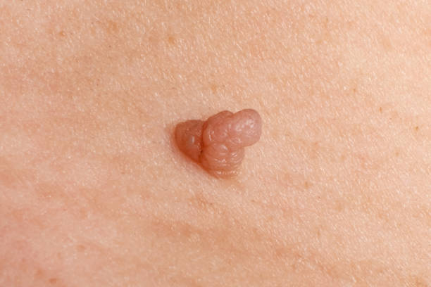 cancer papilloma on the skin, wart close up stock photo